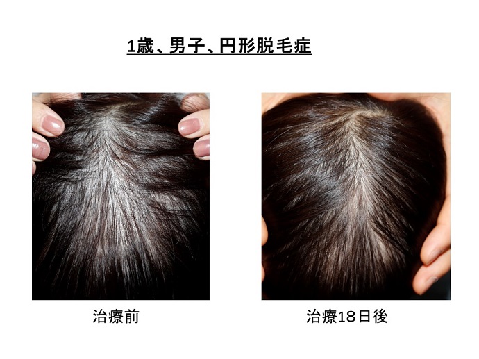 円形脱毛症　病院
